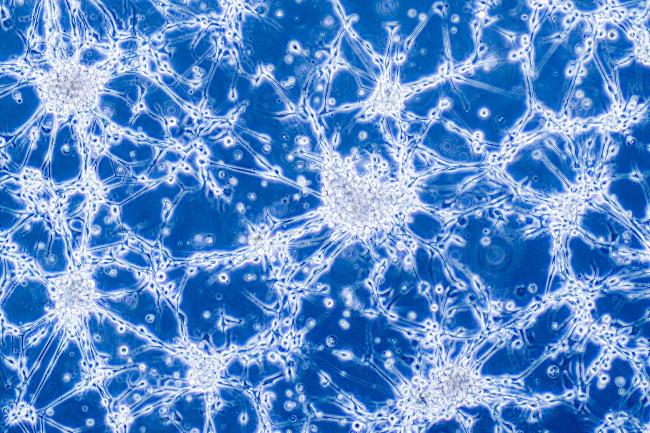 Glioblastoma brain cancer cells under microscope